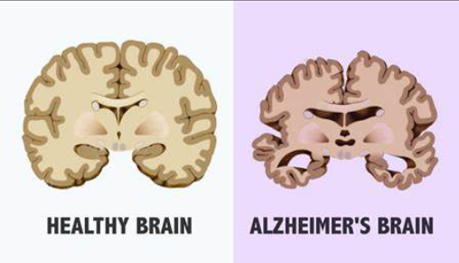 Alzheimer disease